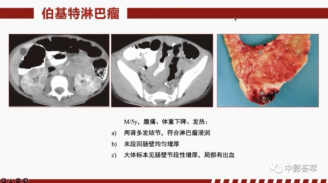 影像PPT - 【PPT】胃肠淋巴瘤及小肠肿瘤性的病变综述-41