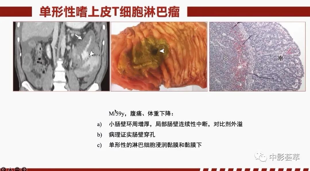 影像PPT - 【PPT】胃肠淋巴瘤及小肠肿瘤性的病变综述-46