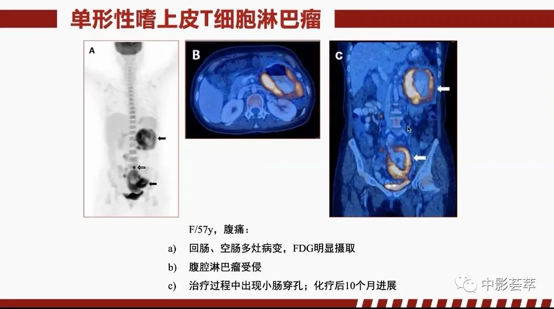 影像PPT - 【PPT】胃肠淋巴瘤及小肠肿瘤性的病变综述-47