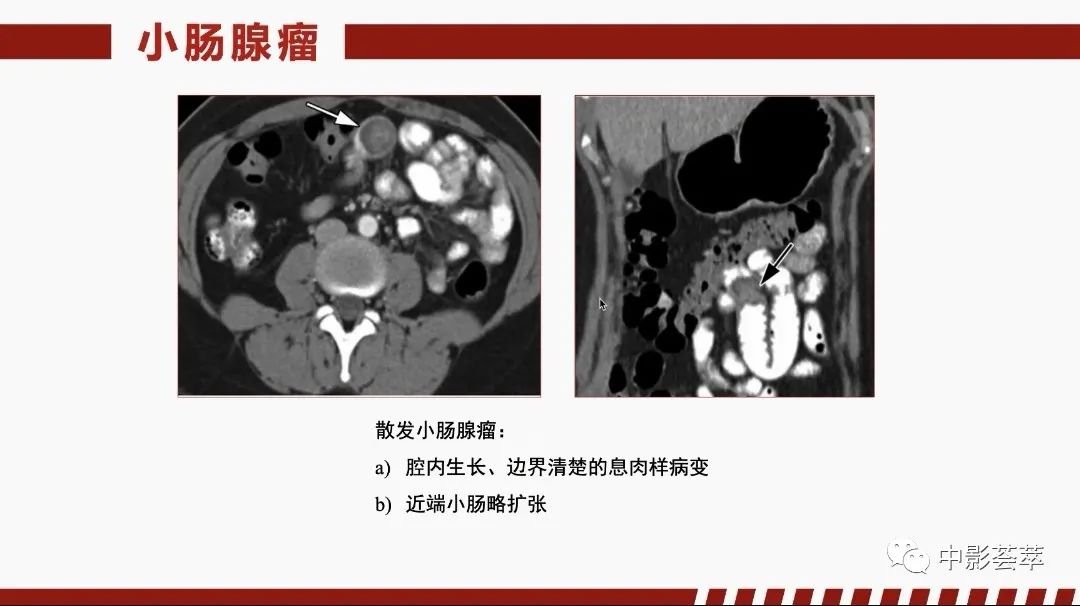 影像PPT - 【PPT】胃肠淋巴瘤及小肠肿瘤性的病变综述-51