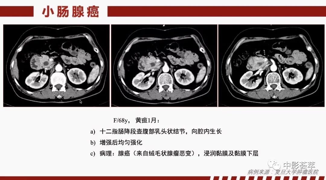 影像PPT - 【PPT】胃肠淋巴瘤及小肠肿瘤性的病变综述-54