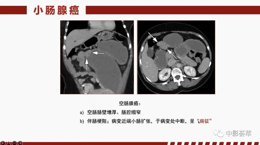 影像PPT - 【PPT】胃肠淋巴瘤及小肠肿瘤性的病变综述-56