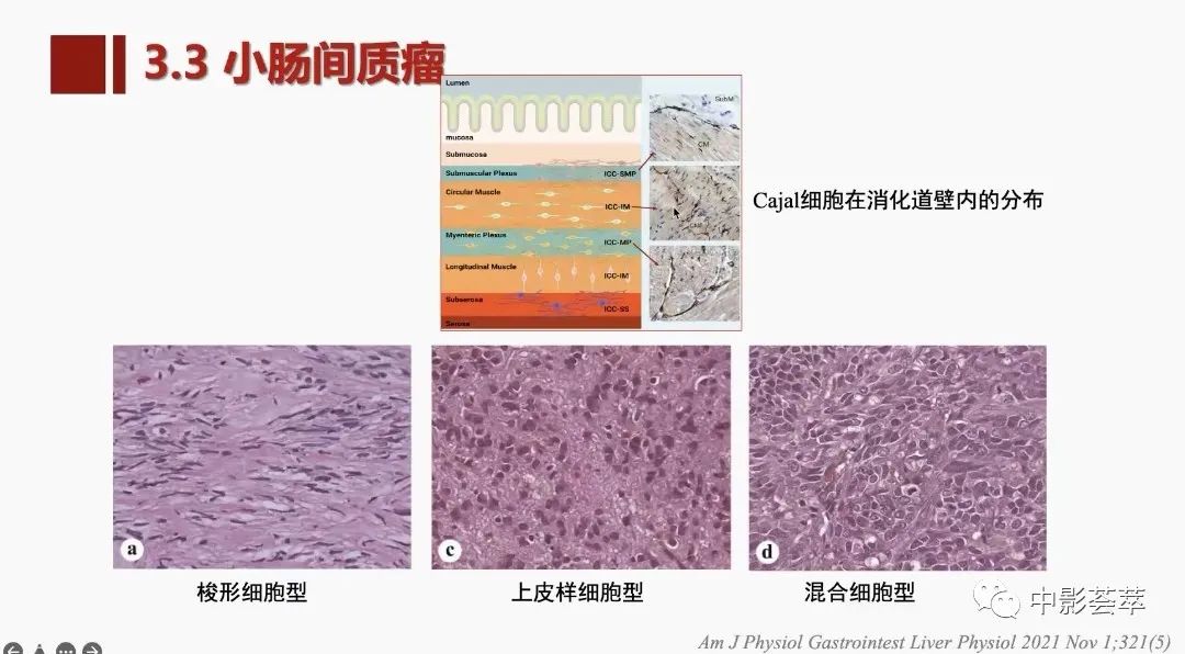 影像PPT - 【PPT】胃肠淋巴瘤及小肠肿瘤性的病变综述-58