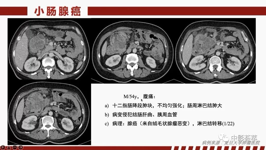 影像PPT - 【PPT】胃肠淋巴瘤及小肠肿瘤性的病变综述-55