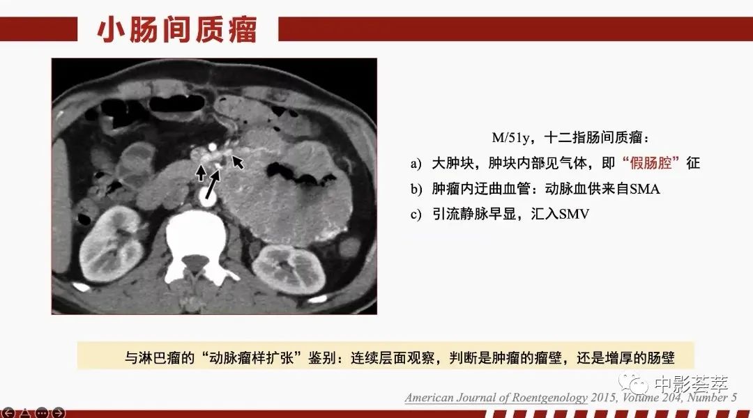 影像PPT - 【PPT】胃肠淋巴瘤及小肠肿瘤性的病变综述-62