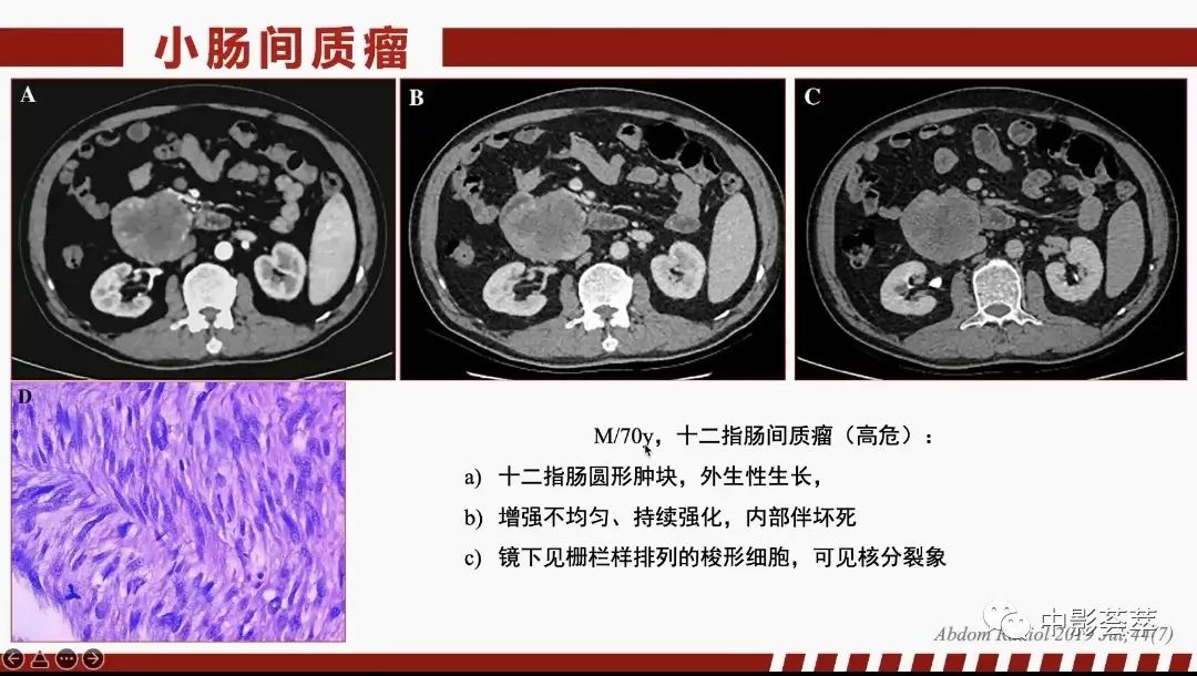 影像PPT - 【PPT】胃肠淋巴瘤及小肠肿瘤性的病变综述-61
