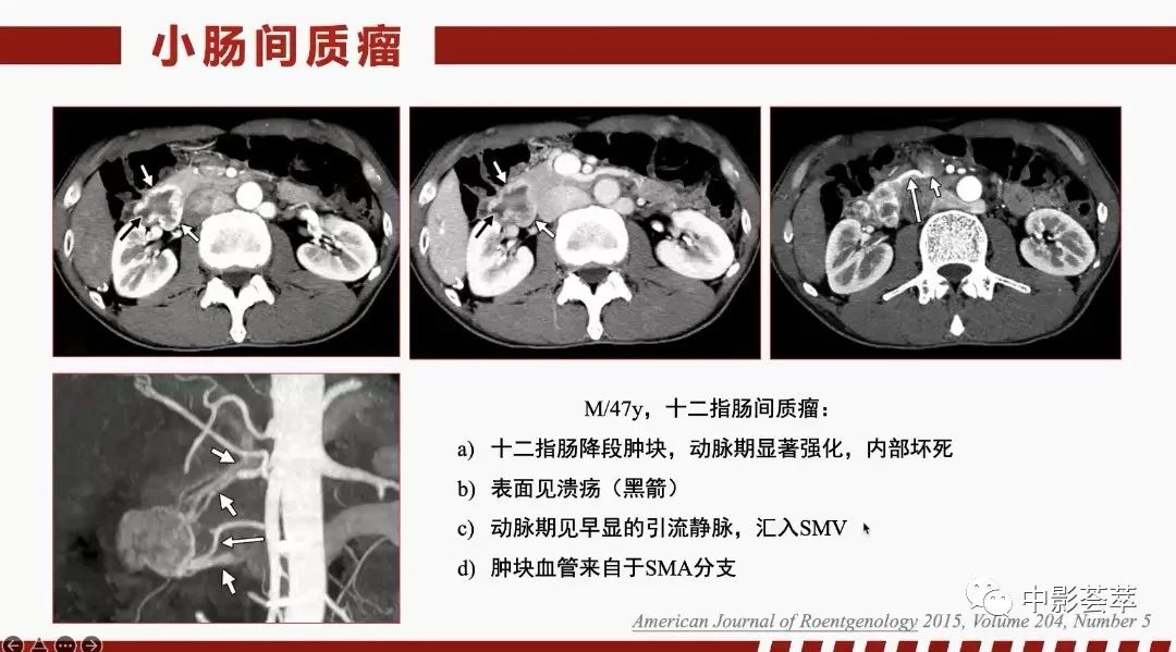 影像PPT - 【PPT】胃肠淋巴瘤及小肠肿瘤性的病变综述-60