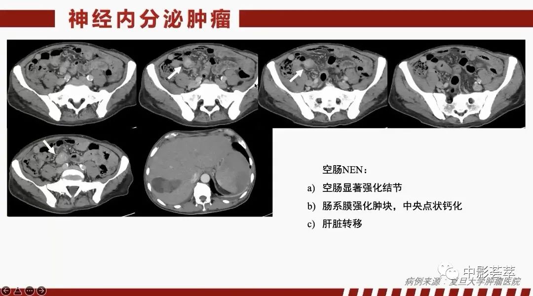 影像PPT - 【PPT】胃肠淋巴瘤及小肠肿瘤性的病变综述-67