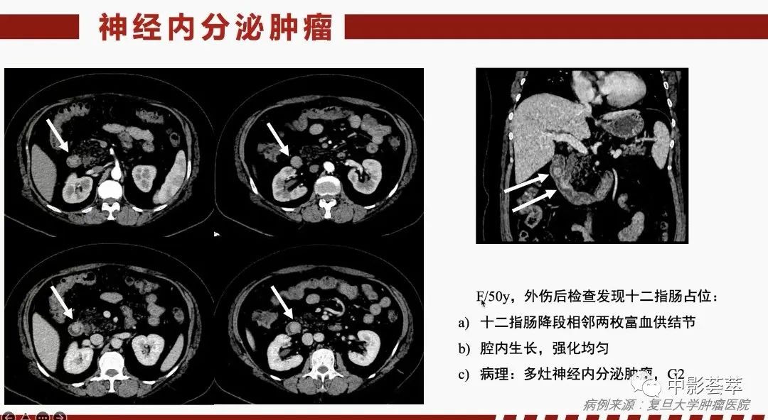 影像PPT - 【PPT】胃肠淋巴瘤及小肠肿瘤性的病变综述-68