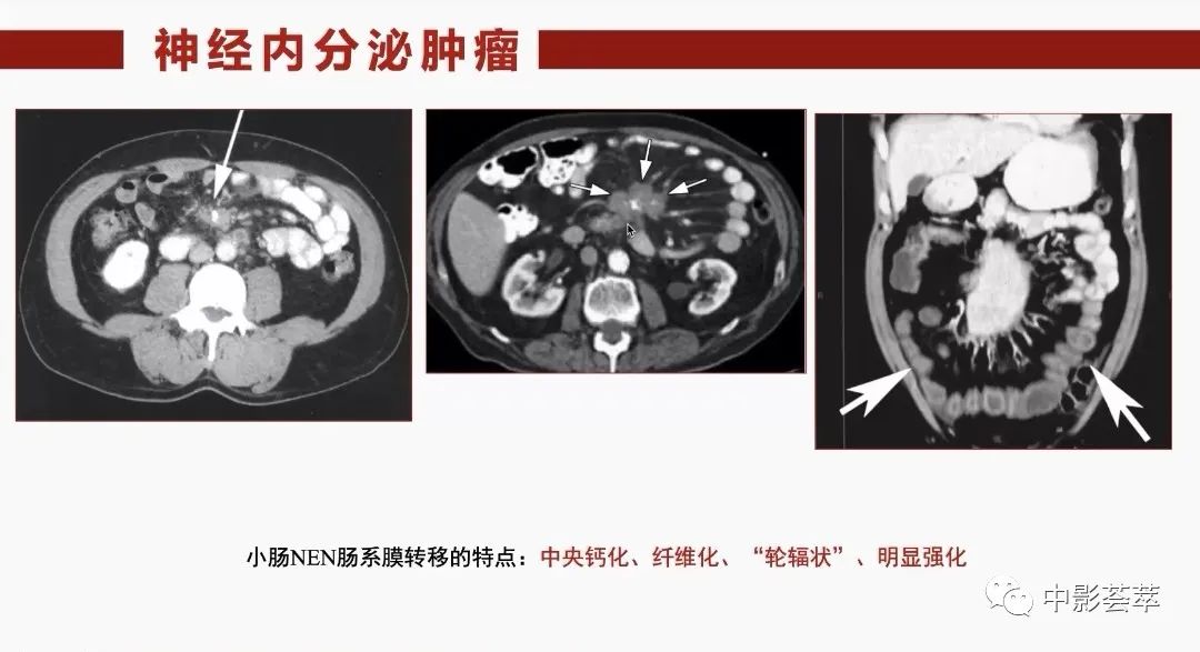 影像PPT - 【PPT】胃肠淋巴瘤及小肠肿瘤性的病变综述-69
