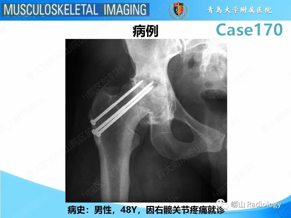影像PPT - 【PPT】股骨术后并发症-2