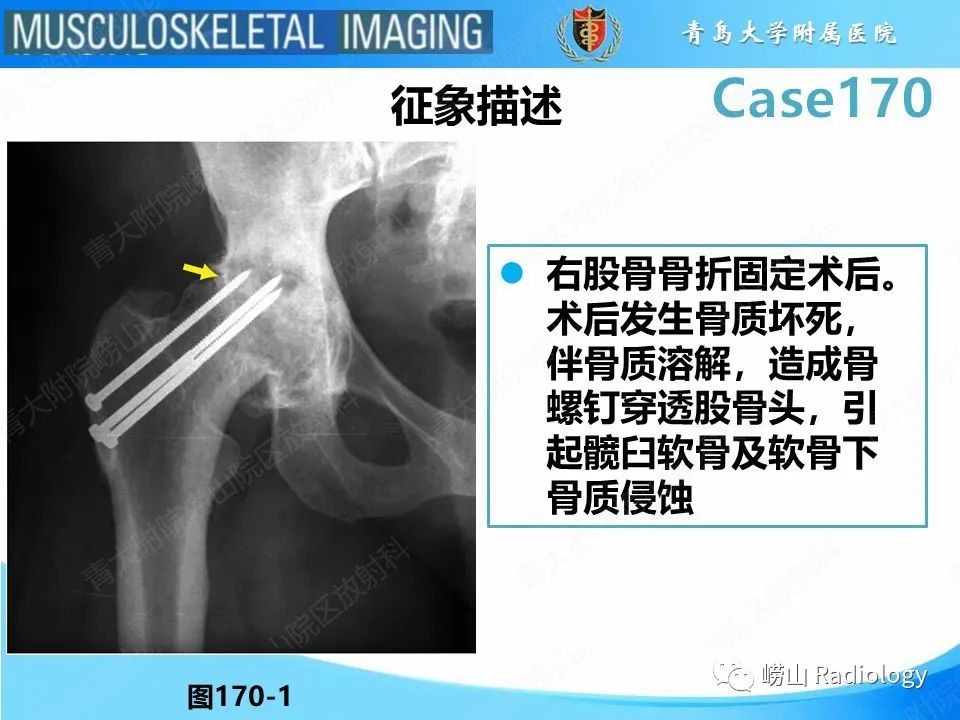 影像PPT - 【PPT】股骨术后并发症-11