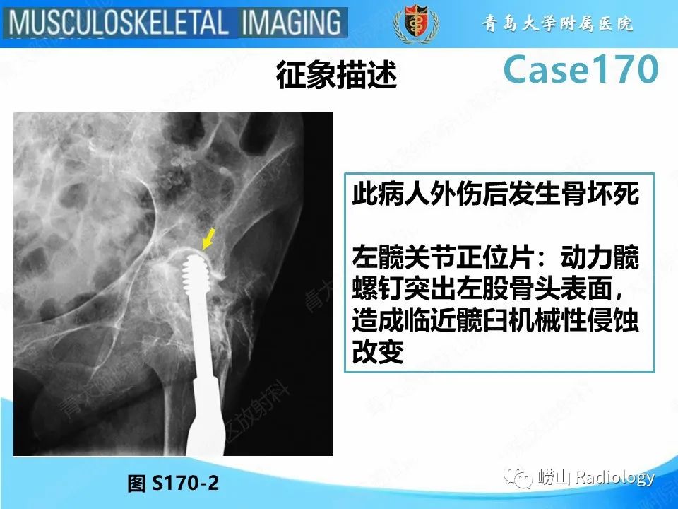 影像PPT - 【PPT】股骨术后并发症-12