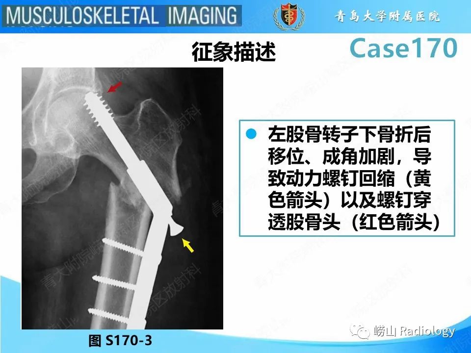 影像PPT - 【PPT】股骨术后并发症-13