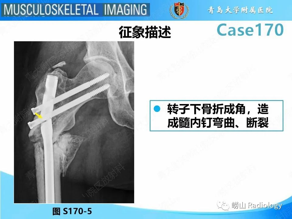 影像PPT - 【PPT】股骨术后并发症-15