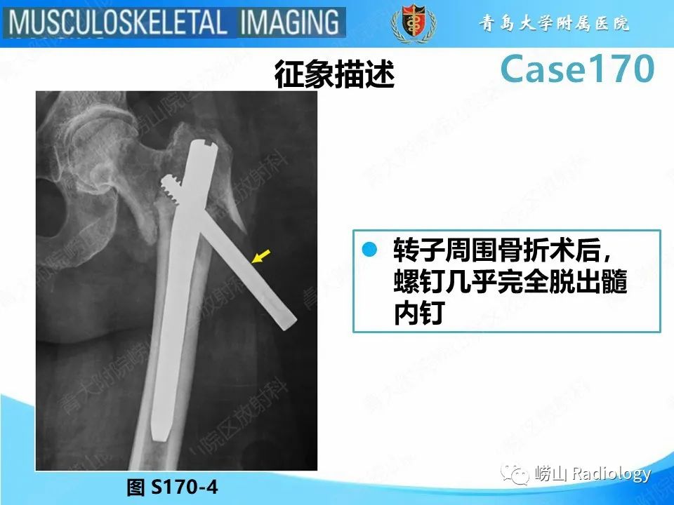 影像PPT - 【PPT】股骨术后并发症-14