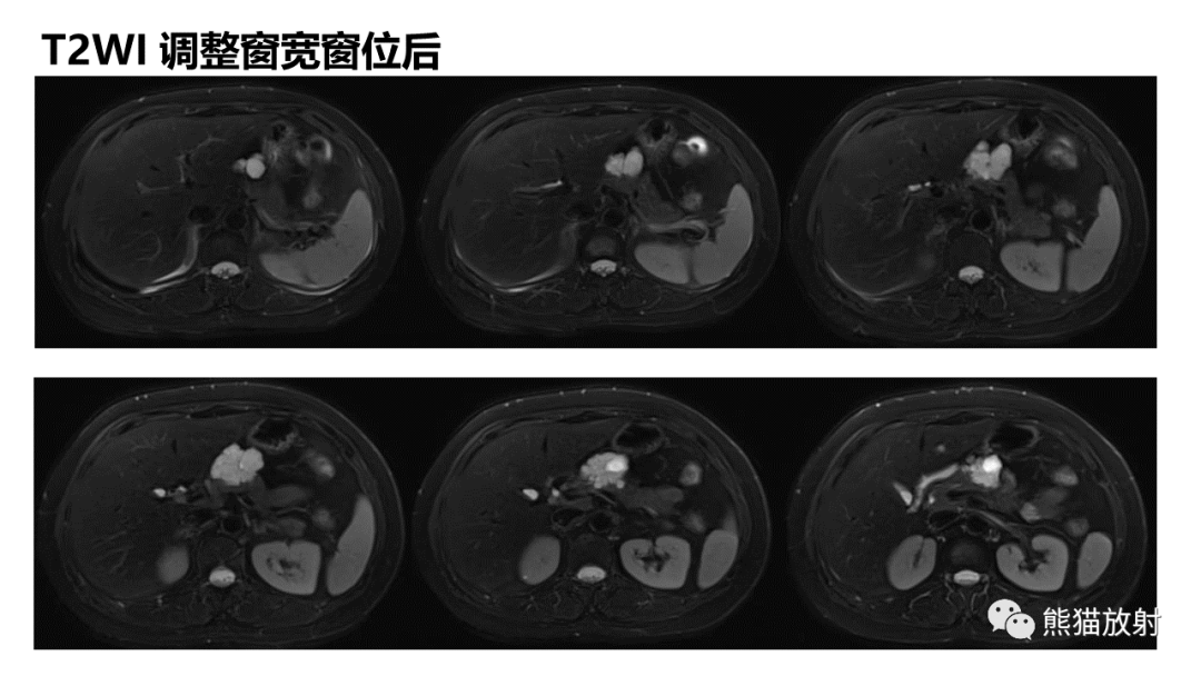 影像PPT - 【病例】胰腺浆液性囊腺瘤 VS 粘液性囊腺瘤-5