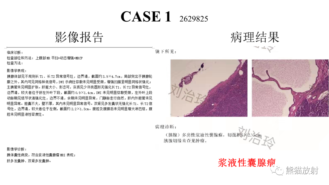 影像PPT - 【病例】胰腺浆液性囊腺瘤 VS 粘液性囊腺瘤-29