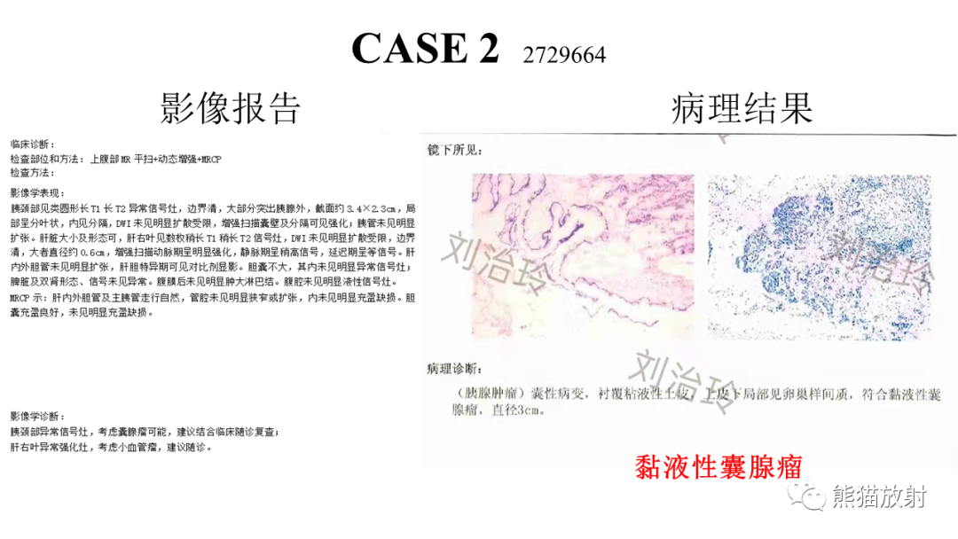 影像PPT - 【病例】胰腺浆液性囊腺瘤 VS 粘液性囊腺瘤-30