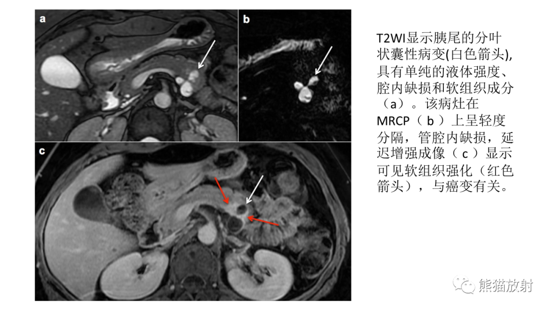 影像PPT - 【病例】胰腺浆液性囊腺瘤 VS 粘液性囊腺瘤-36