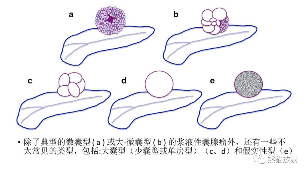 影像PPT - 【病例】胰腺浆液性囊腺瘤 VS 粘液性囊腺瘤-39