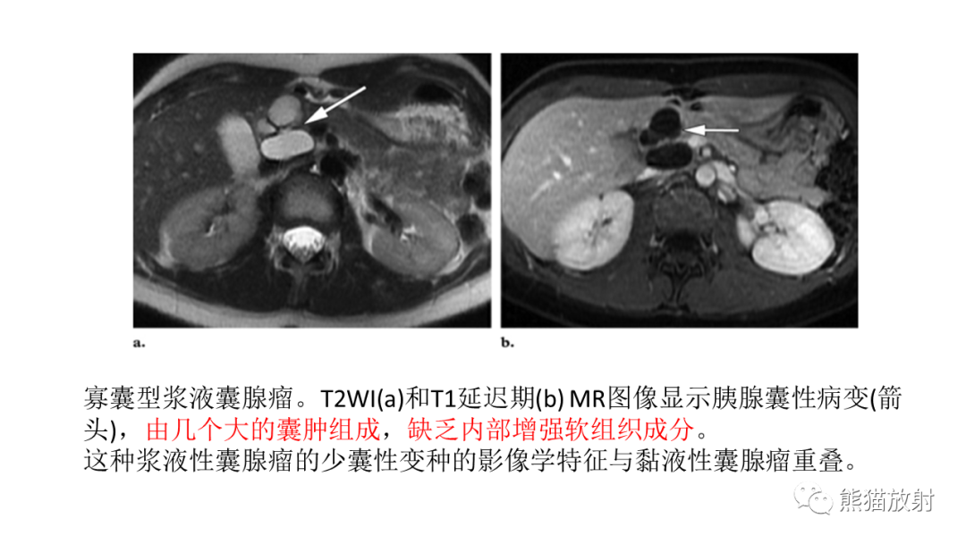 影像PPT - 【病例】胰腺浆液性囊腺瘤 VS 粘液性囊腺瘤-44