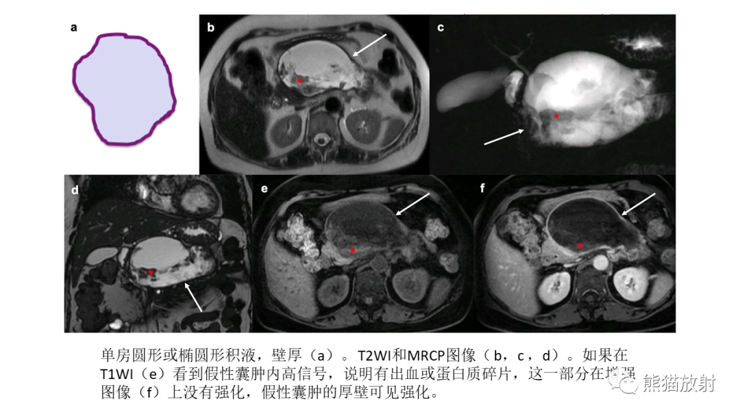 影像PPT - 【病例】胰腺浆液性囊腺瘤 VS 粘液性囊腺瘤-49