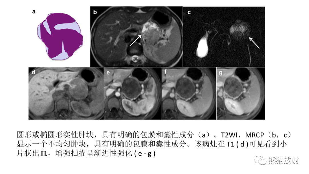 影像PPT - 【病例】胰腺浆液性囊腺瘤 VS 粘液性囊腺瘤-52