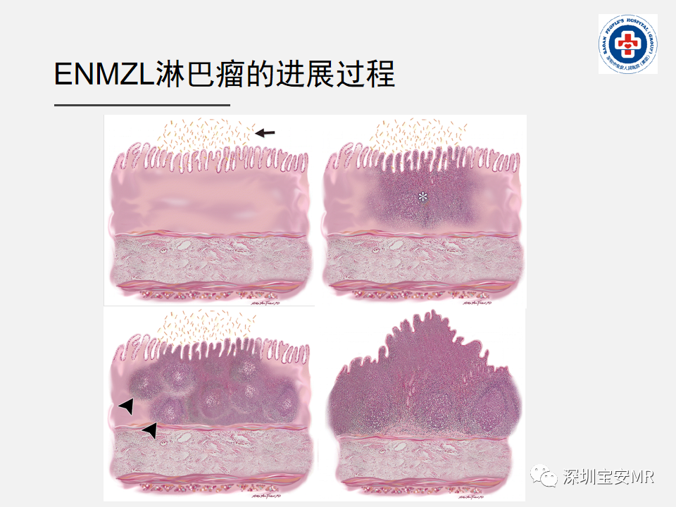 影像PPT - 【PPT】胃肠道淋巴瘤-7