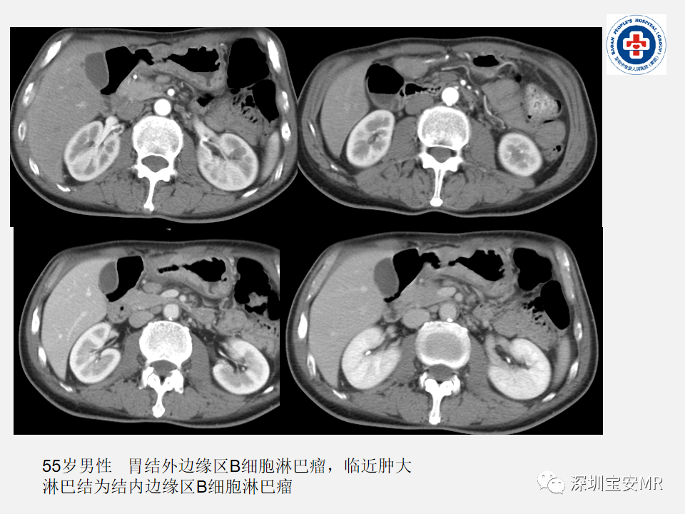 影像PPT - 【PPT】胃肠道淋巴瘤-12