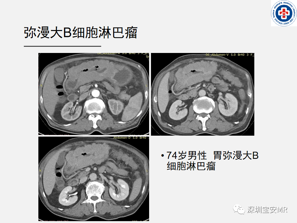 影像PPT - 【PPT】胃肠道淋巴瘤-14