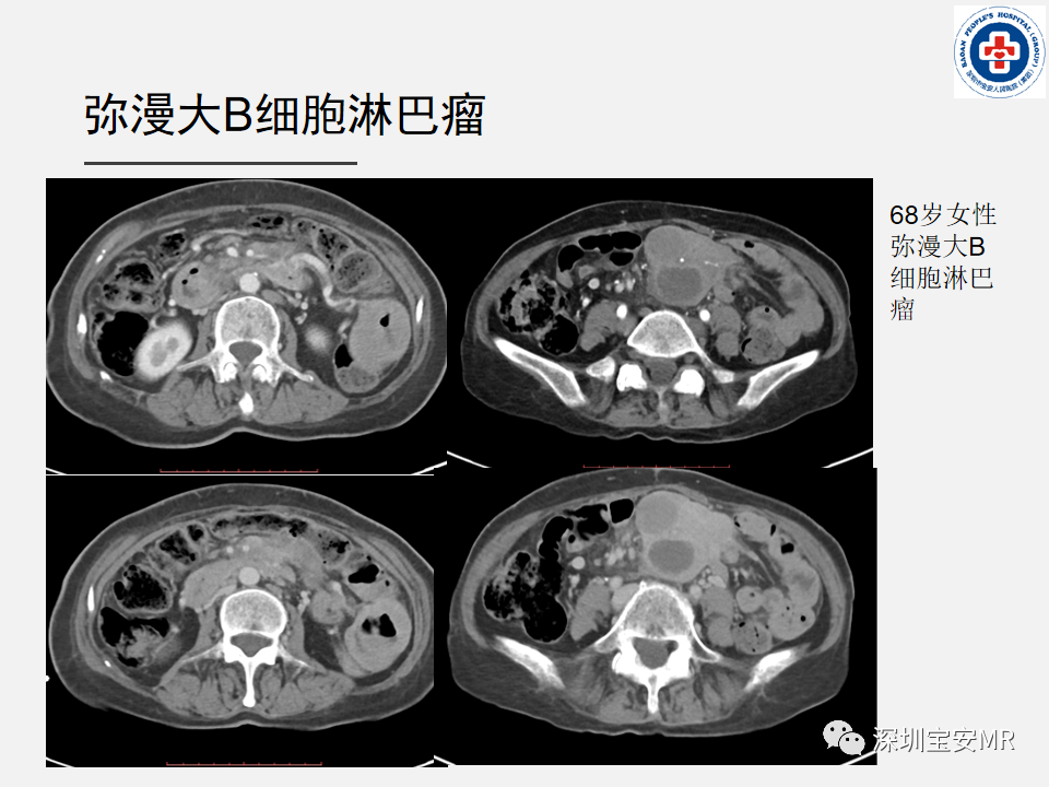 影像PPT - 【PPT】胃肠道淋巴瘤-15
