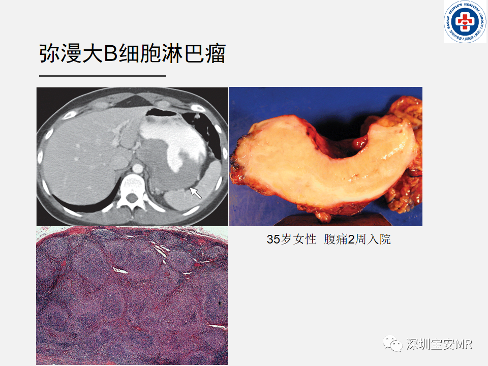 影像PPT - 【PPT】胃肠道淋巴瘤-17