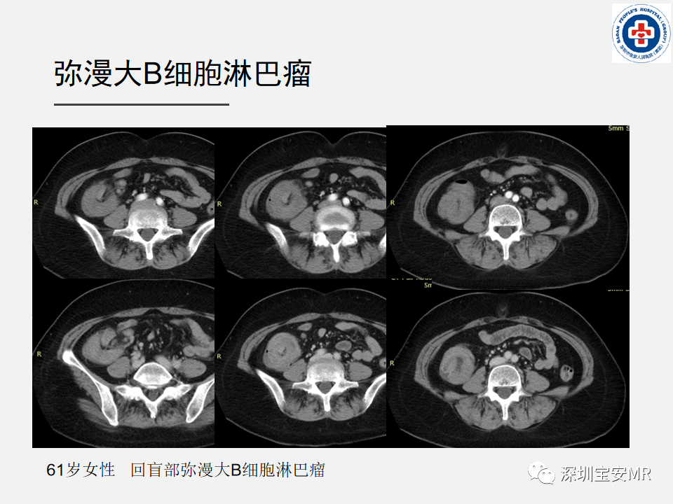 影像PPT - 【PPT】胃肠道淋巴瘤-16