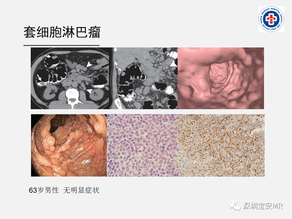 影像PPT - 【PPT】胃肠道淋巴瘤-21