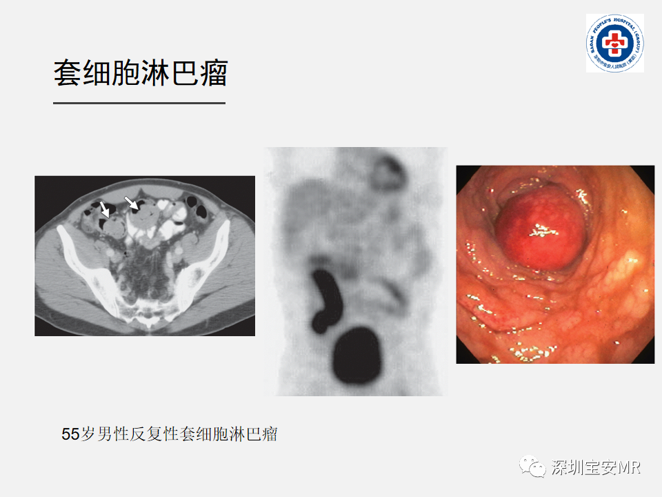影像PPT - 【PPT】胃肠道淋巴瘤-22