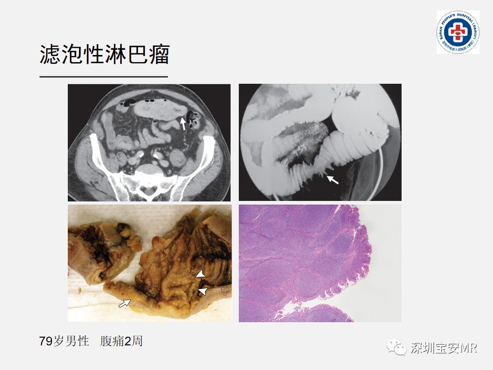 影像PPT - 【PPT】胃肠道淋巴瘤-24