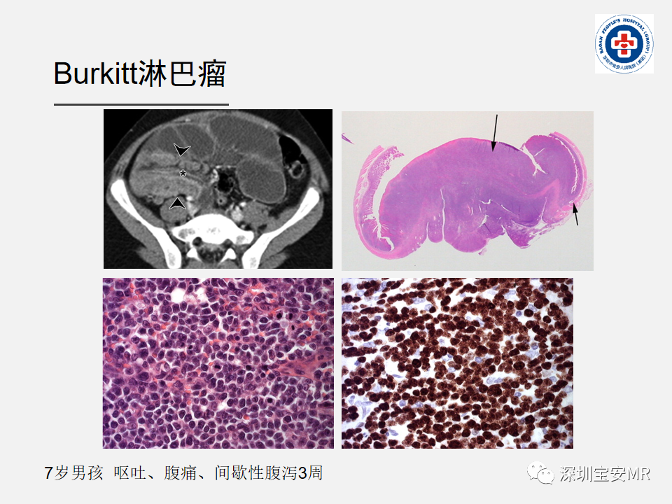 影像PPT - 【PPT】胃肠道淋巴瘤-26
