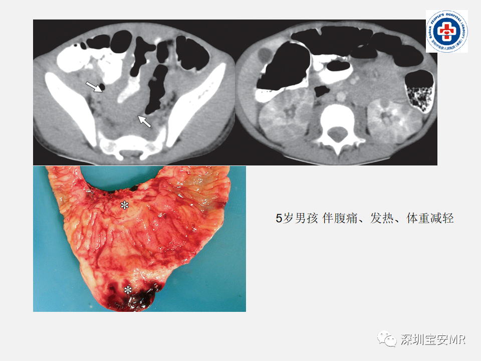 影像PPT - 【PPT】胃肠道淋巴瘤-27