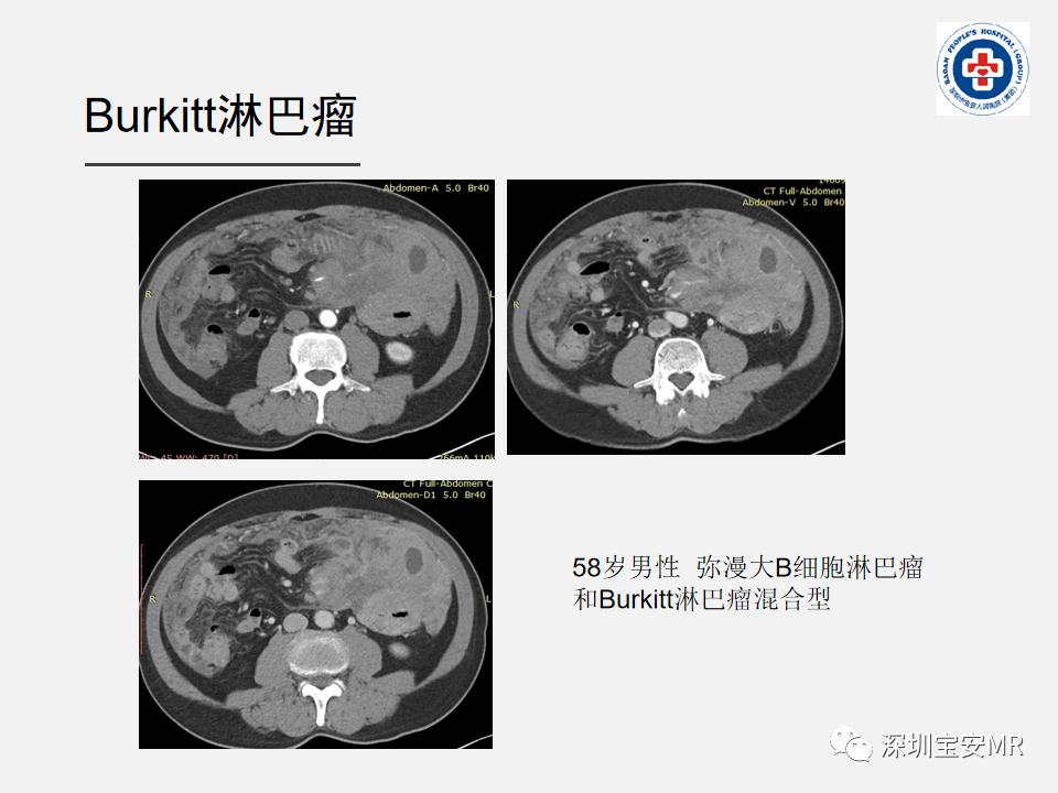 影像PPT - 【PPT】胃肠道淋巴瘤-28