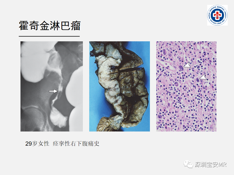 影像PPT - 【PPT】胃肠道淋巴瘤-30