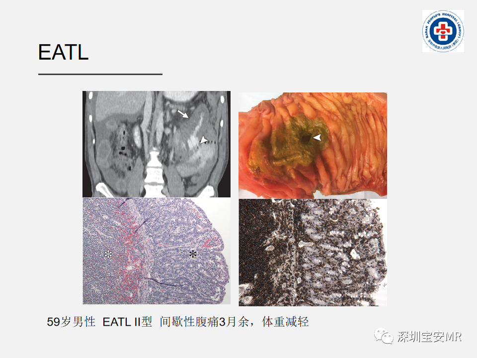 影像PPT - 【PPT】胃肠道淋巴瘤-32