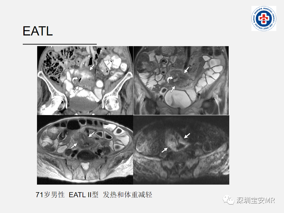 影像PPT - 【PPT】胃肠道淋巴瘤-33