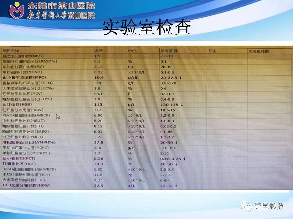 影像PPT - 【PPT】乏脂肪肾血管平滑肌脂肪瘤影像诊断-4
