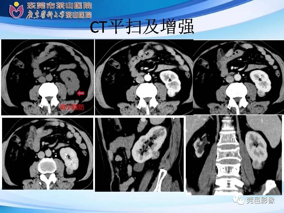 影像PPT - 【PPT】乏脂肪肾血管平滑肌脂肪瘤影像诊断-7