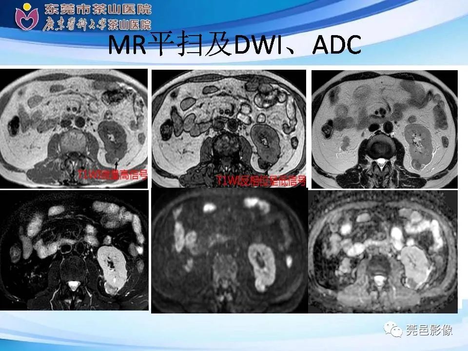 影像PPT - 【PPT】乏脂肪肾血管平滑肌脂肪瘤影像诊断-8