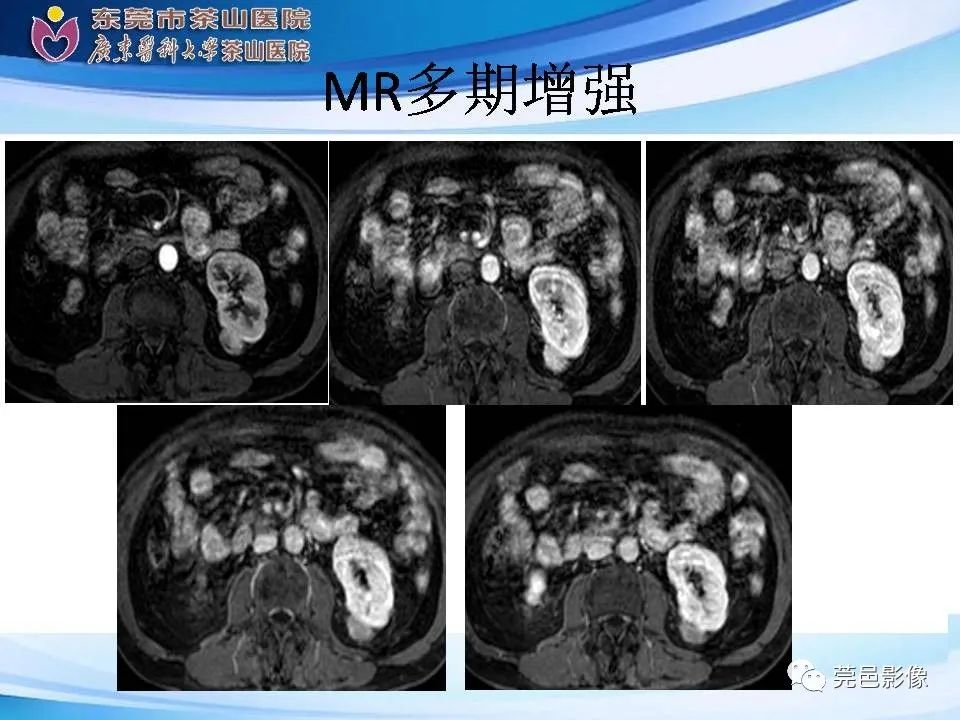 影像PPT - 【PPT】乏脂肪肾血管平滑肌脂肪瘤影像诊断-9