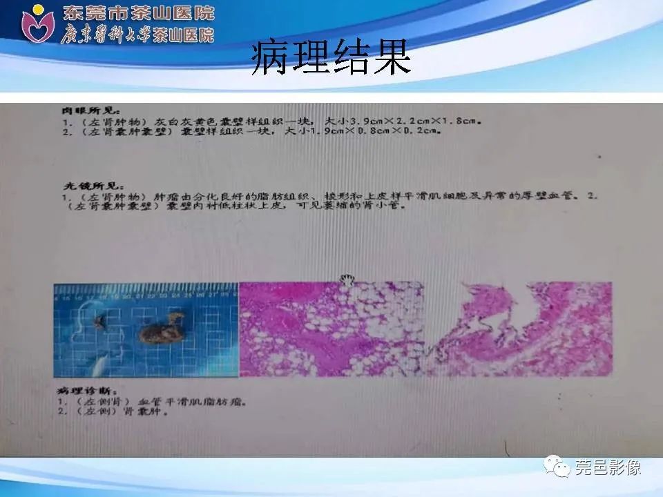 影像PPT - 【PPT】乏脂肪肾血管平滑肌脂肪瘤影像诊断-12