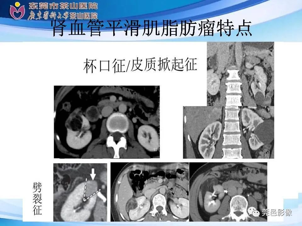 影像PPT - 【PPT】乏脂肪肾血管平滑肌脂肪瘤影像诊断-16