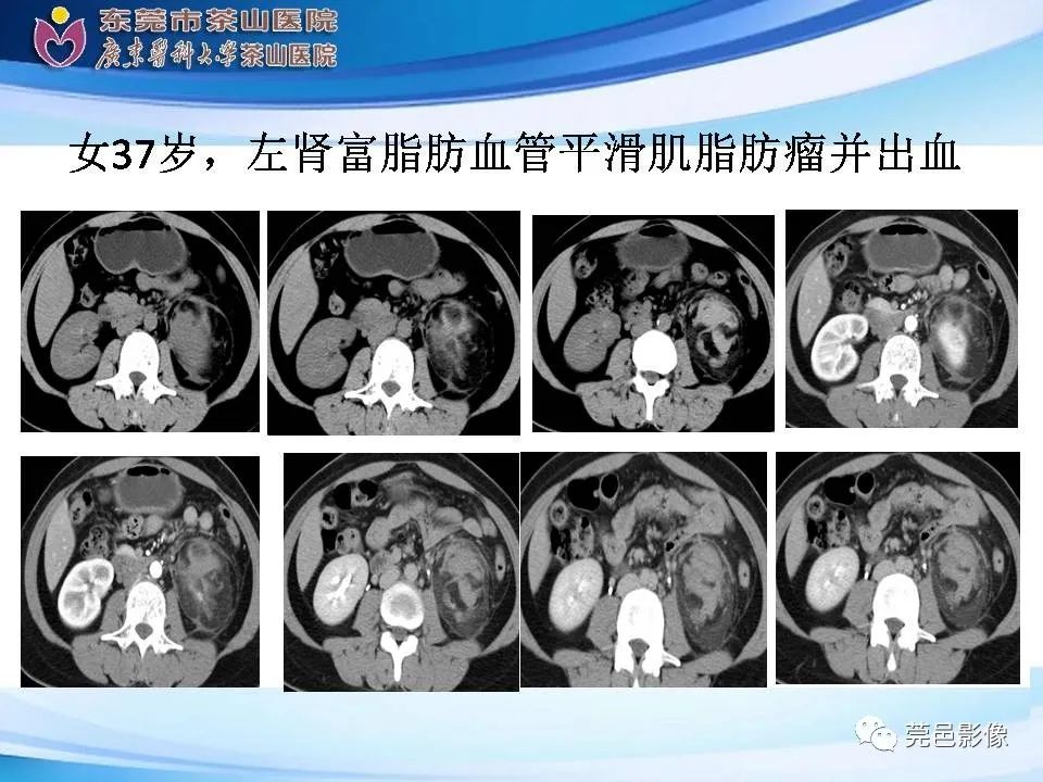 影像PPT - 【PPT】乏脂肪肾血管平滑肌脂肪瘤影像诊断-17